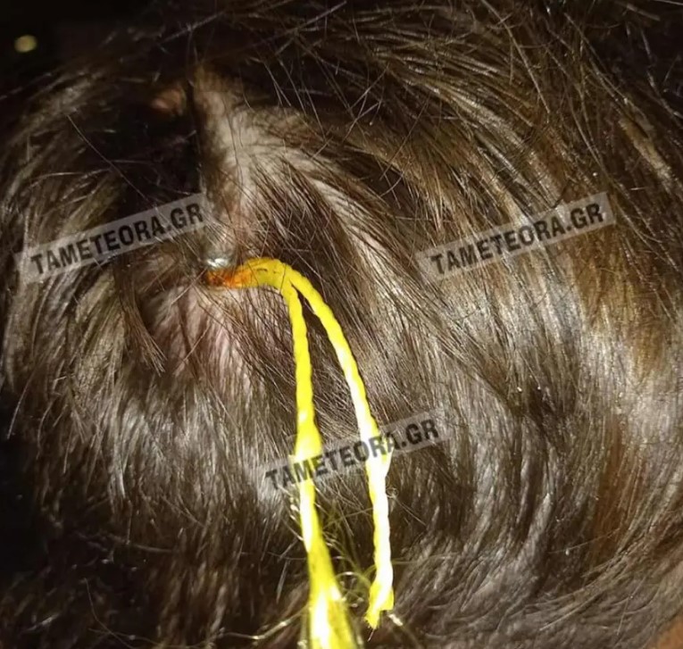 Καλαμπάκα: Καρφί 5 εκατοστών σφηνώθηκε στο κεφάλι άνδρα (φωτο)